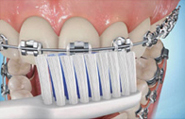 Perfect Smile ortho Brushing steps